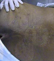 Erythematous, excoriated rash over the lumbar region.